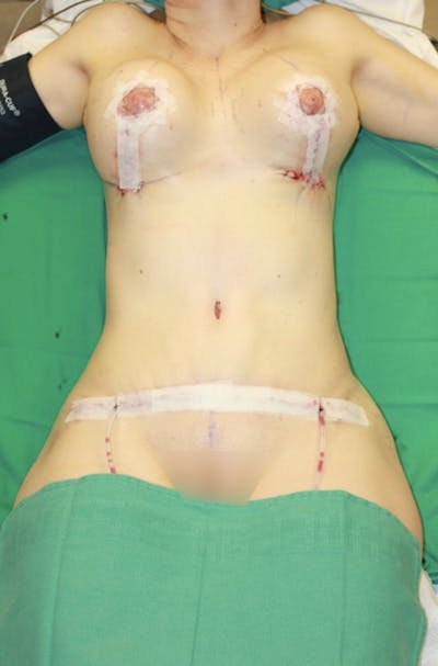 High Definition Mommy Makeover Before & After Gallery - Patient 147054 - Image 2