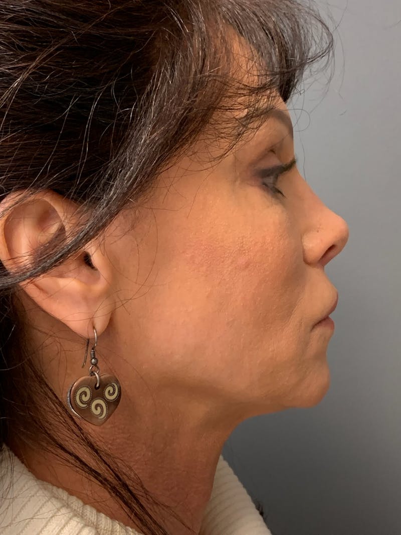 Deep Plane Facelift Before & After Gallery - Patient 333423 - Image 5