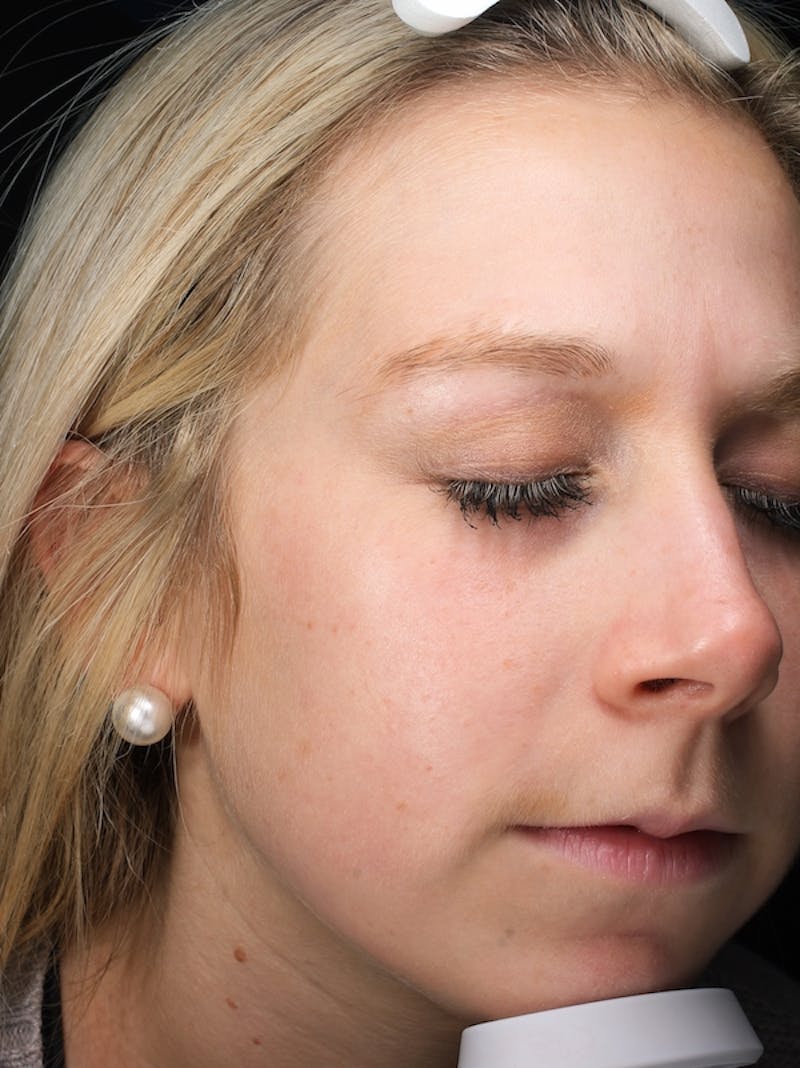 Lasers & Light Before & After Gallery - Patient 216774 - Image 4