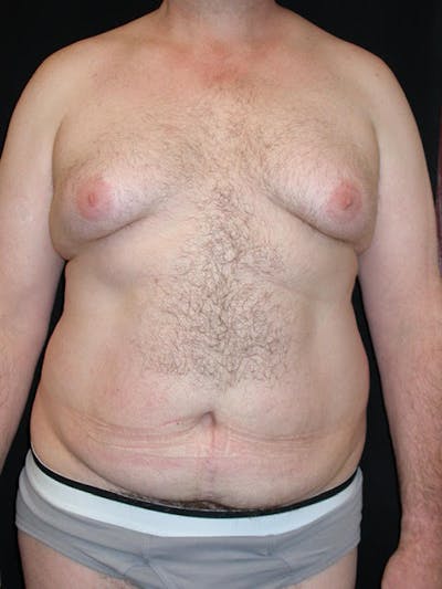 Liposuction Men Before & After Gallery - Patient 338955 - Image 1