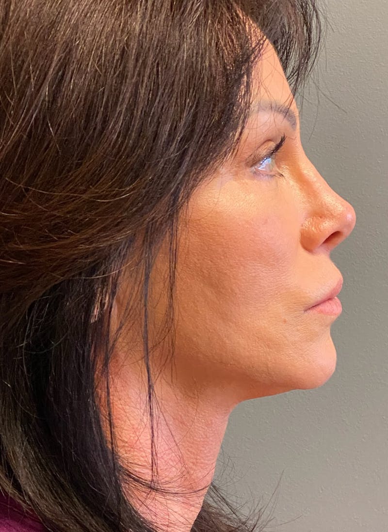 Deep Plane Facelift Before & After Gallery - Patient 333423 - Image 6