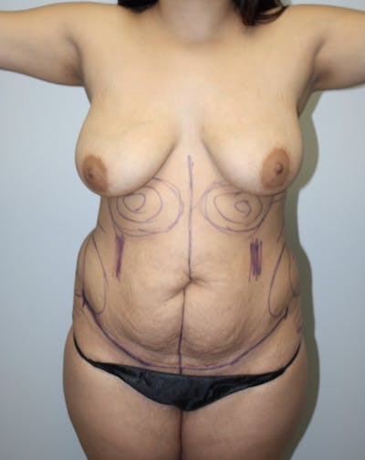 High Definition Mommy Makeover Before & After Gallery - Patient 390194 - Image 1