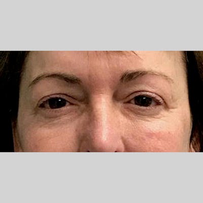 Blepharoplasty Before & After Gallery - Patient 205343 - Image 1