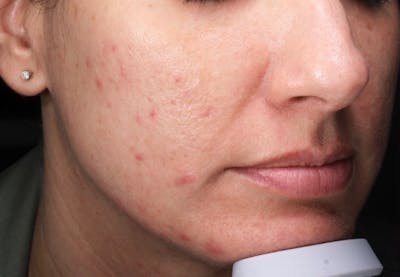 Lasers & Light Before & After Gallery - Patient 369926 - Image 1