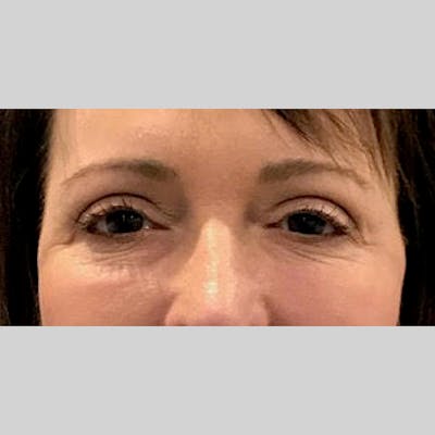 Blepharoplasty Before & After Gallery - Patient 205343 - Image 2