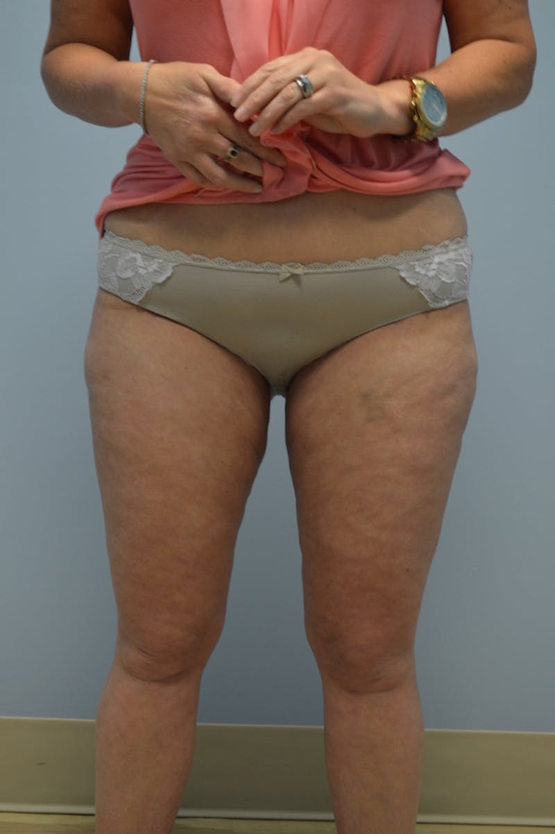 Fat Reduction (Non-Invasive) Before & After Gallery - Patient 283845 - Image 2