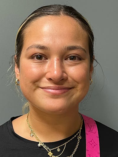 Rhinoplasty Before & After Gallery - Patient 330015 - Image 2