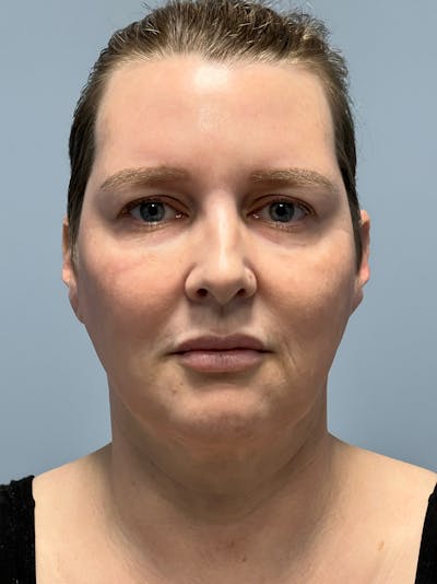 Deep Plane Facelift Before & After Gallery - Patient 260670 - Image 1