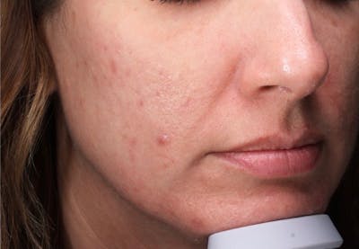 Lasers & Light Before & After Gallery - Patient 369926 - Image 2
