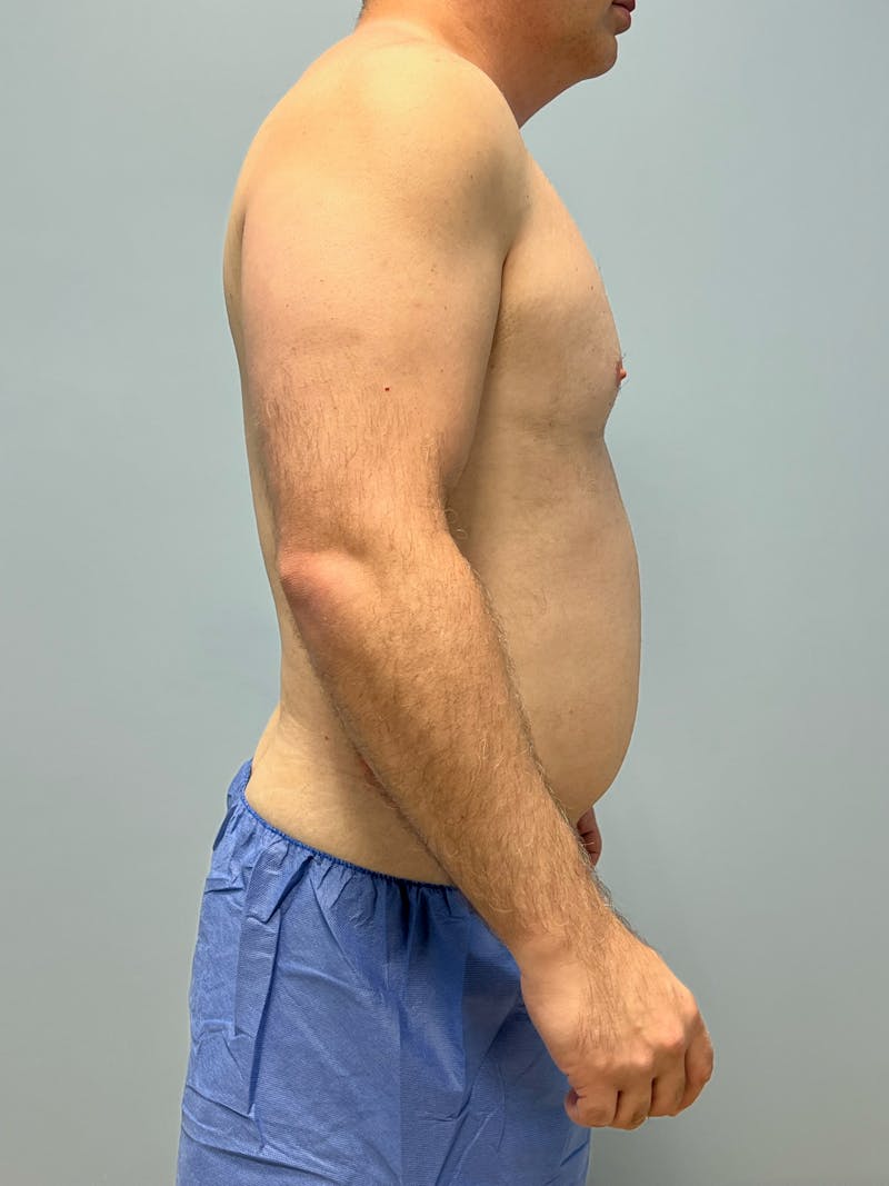 Hi Def Liposuction Before & After Gallery - Patient 306180 - Image 5