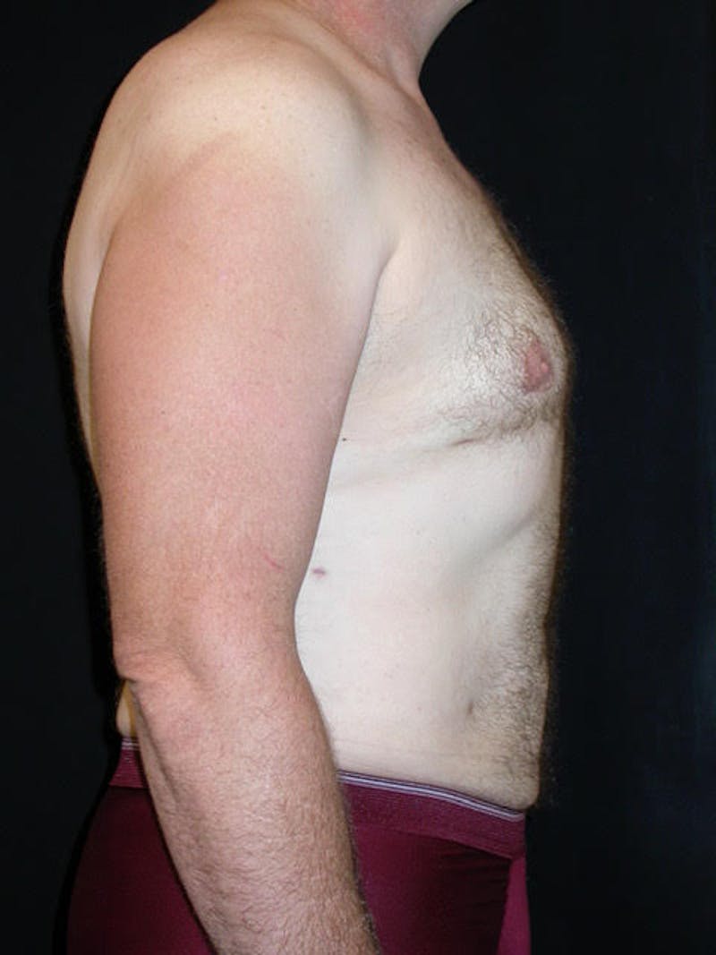 Liposuction Men Before & After Gallery - Patient 338955 - Image 4