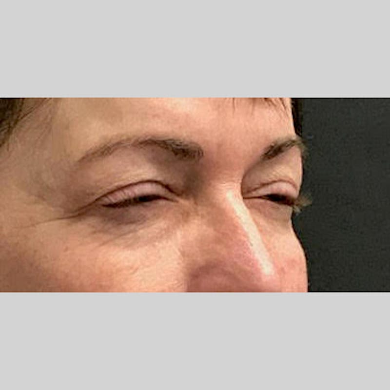 Blepharoplasty Before & After Gallery - Patient 205343 - Image 3