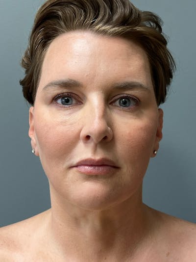 Deep Plane Facelift Before & After Gallery - Patient 260670 - Image 2