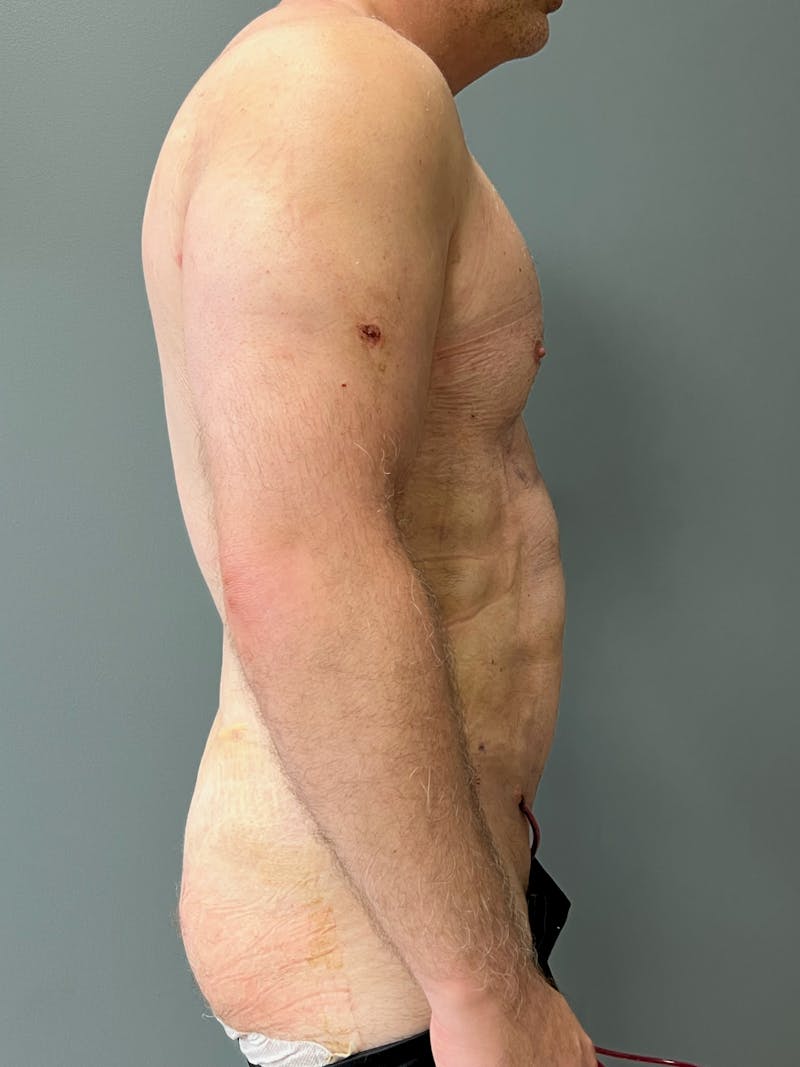 Hi Def Liposuction Before & After Gallery - Patient 306180 - Image 6