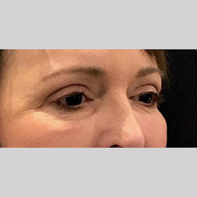 Blepharoplasty Before & After Gallery - Patient 205343 - Image 4