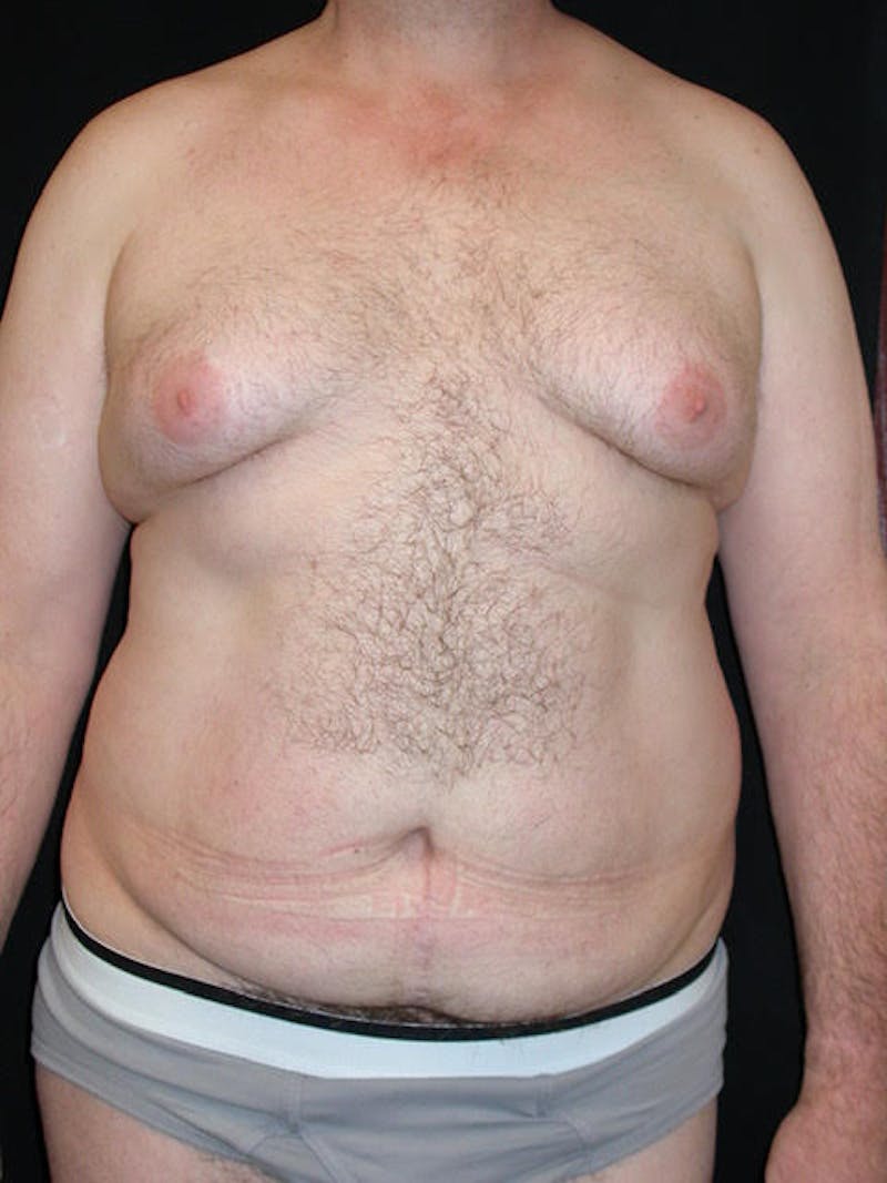 Male Breast (Gynecomastia) Before & After Gallery - Patient 420601 - Image 1