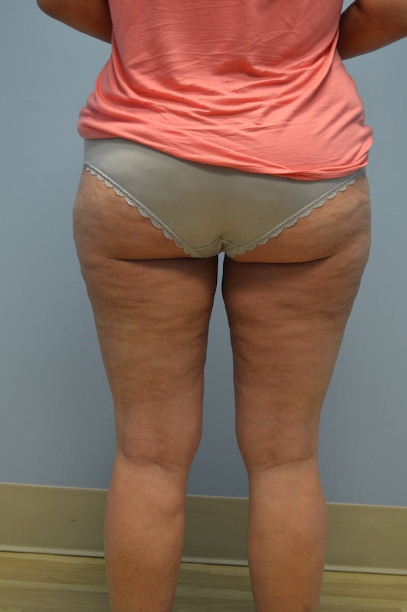Fat Reduction (Non-Invasive) Before & After Gallery - Patient 283845 - Image 4