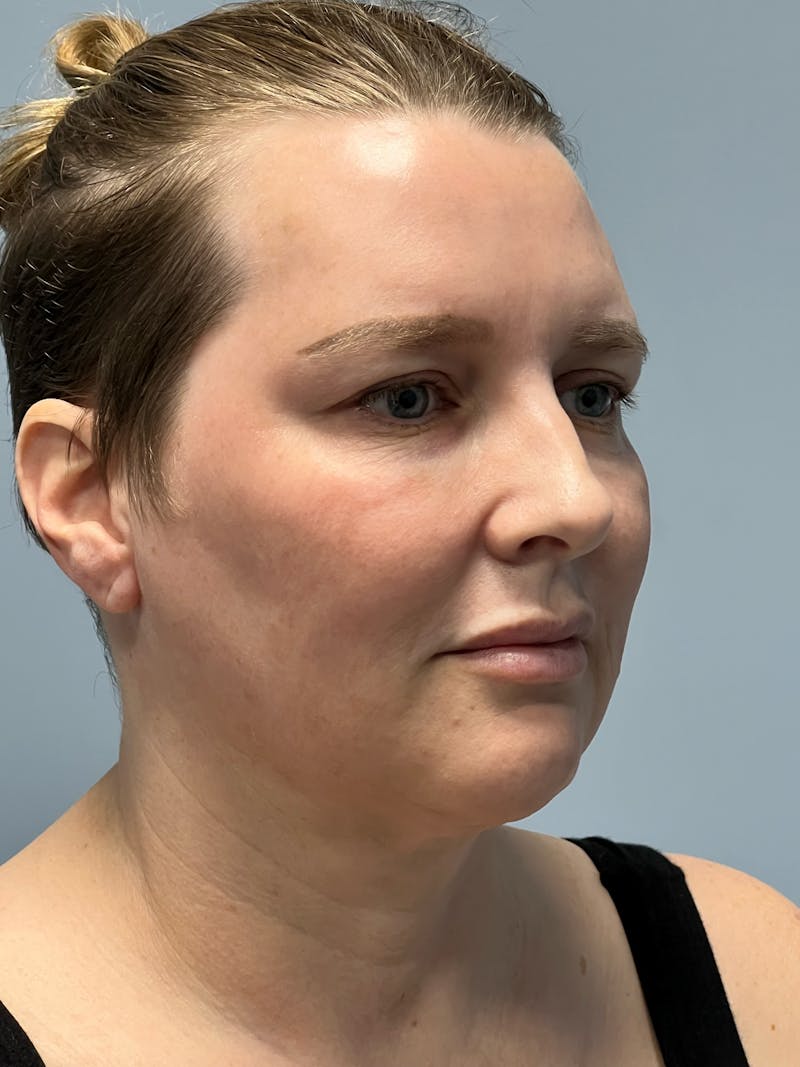 Deep Plane Facelift Before & After Gallery - Patient 260670 - Image 3