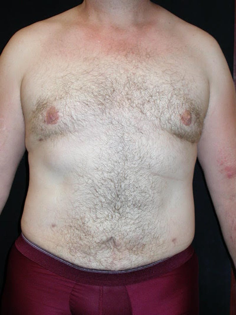 Male Breast (Gynecomastia) Before & After Gallery - Patient 420601 - Image 2