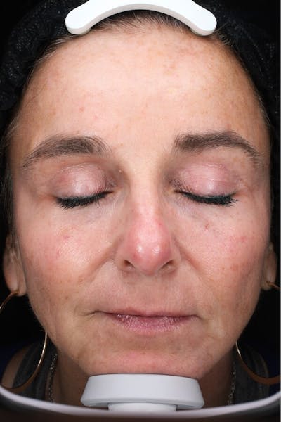 Lasers & Light Before & After Gallery - Patient 793946 - Image 1
