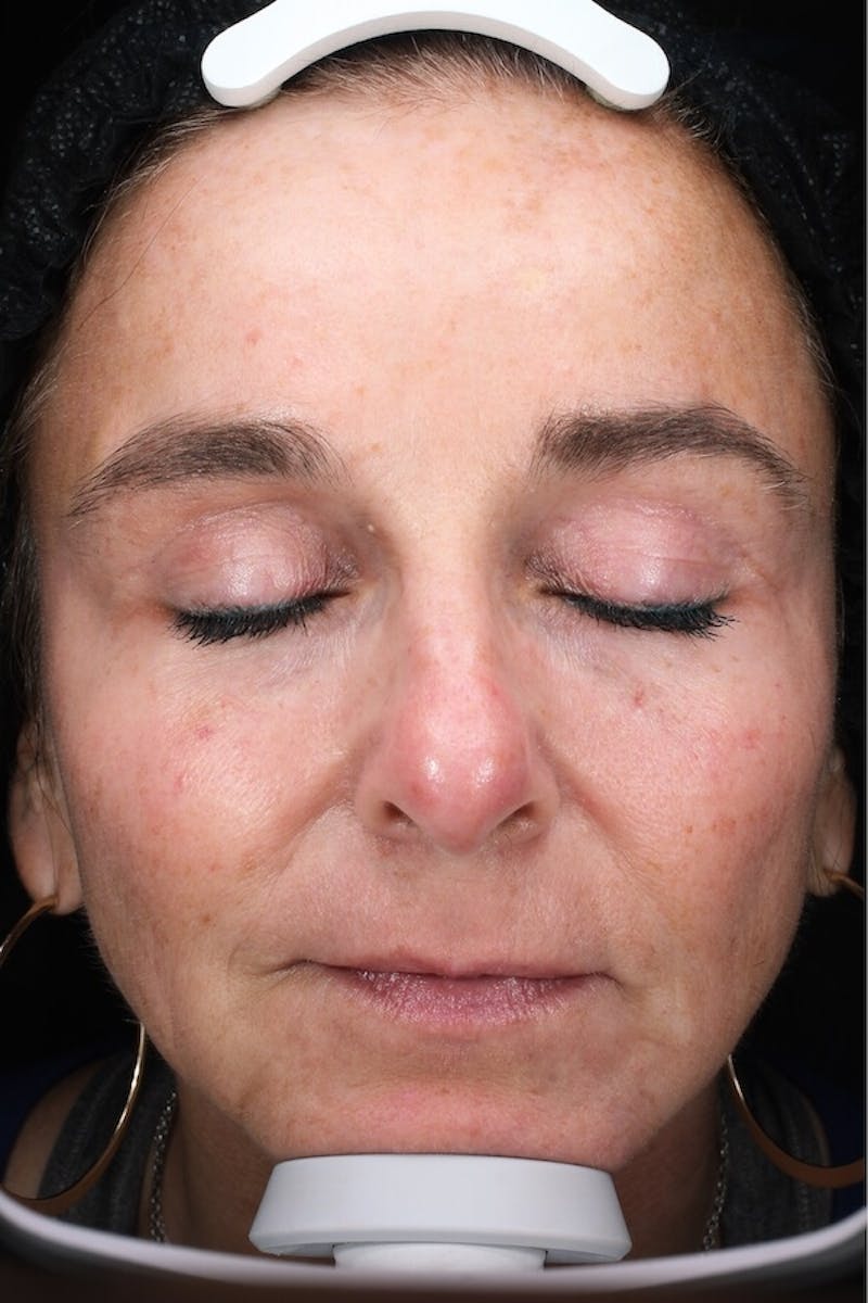 Lasers & Light Before & After Gallery - Patient 793946 - Image 1