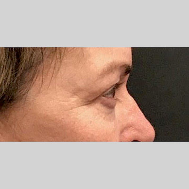 Blepharoplasty Before & After Gallery - Patient 205343 - Image 5