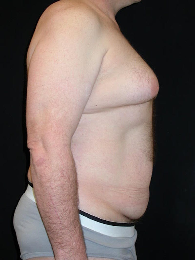 Male Breast (Gynecomastia) Before & After Gallery - Patient 420601 - Image 3