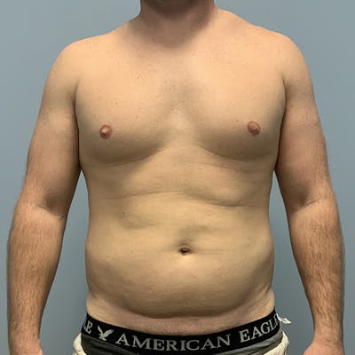 Hi Def Liposuction Before & After Gallery - Patient 310712 - Image 1