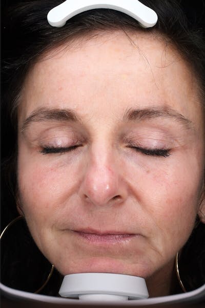 Lasers & Light Before & After Gallery - Patient 793946 - Image 2