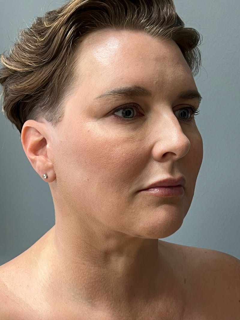 Deep Plane Facelift Before & After Gallery - Patient 260670 - Image 4