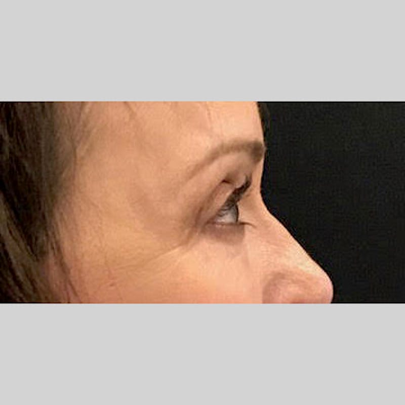 Blepharoplasty Before & After Gallery - Patient 205343 - Image 6