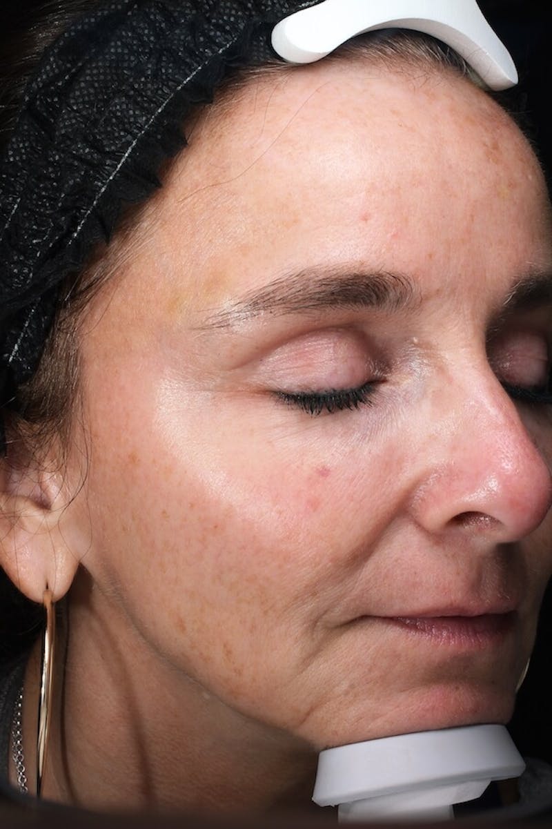 Lasers & Light Before & After Gallery - Patient 793946 - Image 3