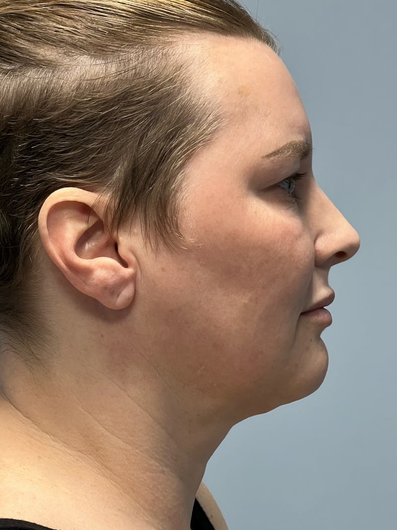 Deep Plane Facelift Before & After Gallery - Patient 260670 - Image 5