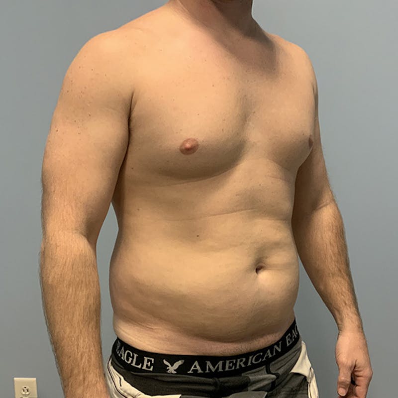 Hi Def Liposuction Before & After Gallery - Patient 310712 - Image 3