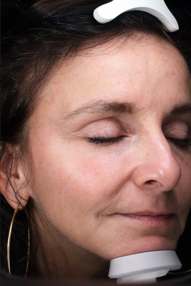 Lasers & Light Before & After Gallery - Patient 793946 - Image 4