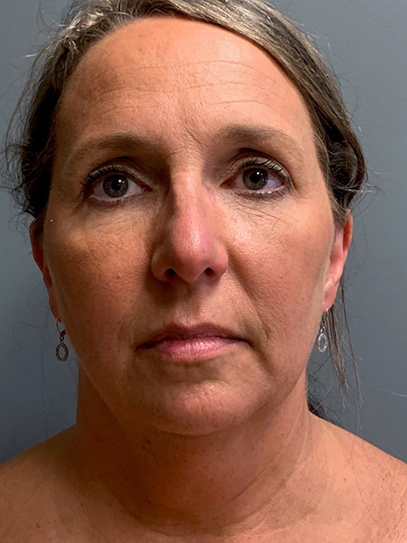 Rhinoplasty Before & After Gallery - Patient 124956 - Image 1