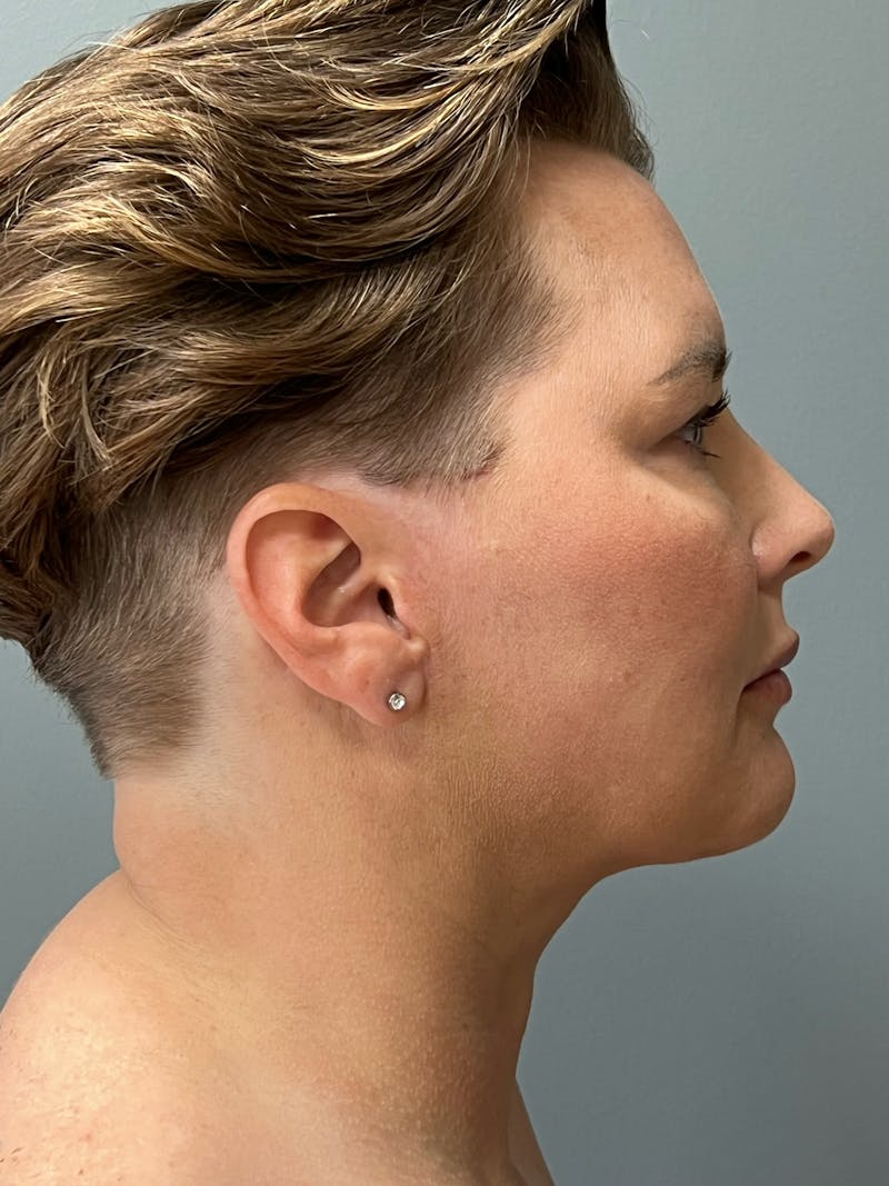 Deep Plane Facelift Before & After Gallery - Patient 260670 - Image 6