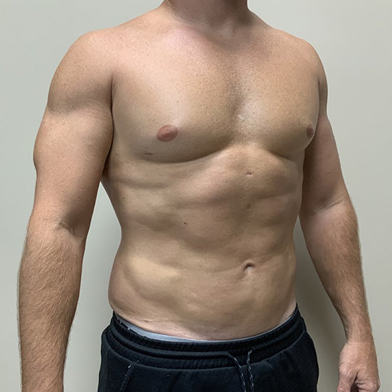 Hi Def Liposuction Before & After Gallery - Patient 310712 - Image 4