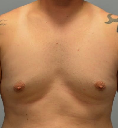 Male Breast (Gynecomastia) Before & After Gallery - Patient 365568 - Image 1