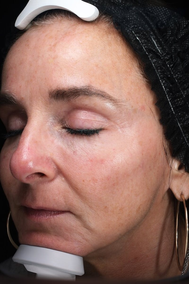 Lasers & Light Before & After Gallery - Patient 793946 - Image 5