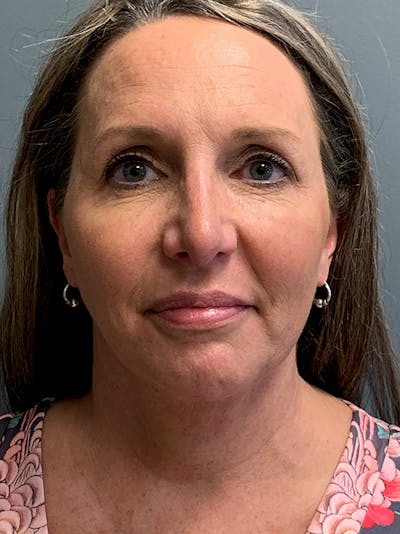 Rhinoplasty Before & After Gallery - Patient 124956 - Image 2