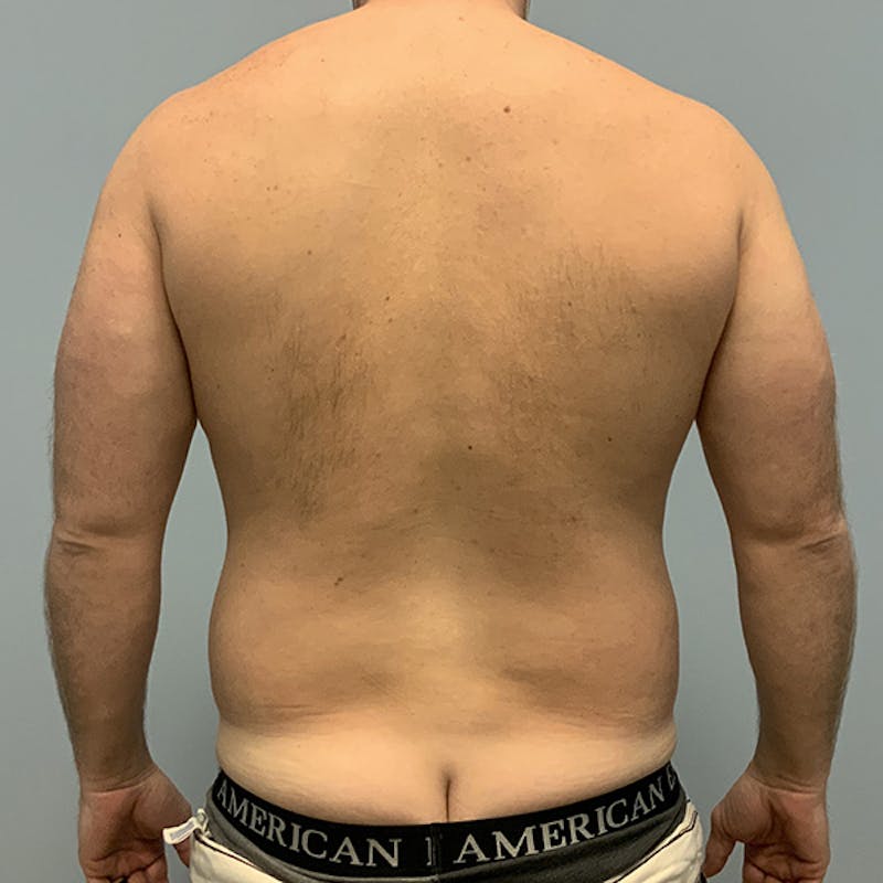Hi Def Liposuction Before & After Gallery - Patient 310712 - Image 5