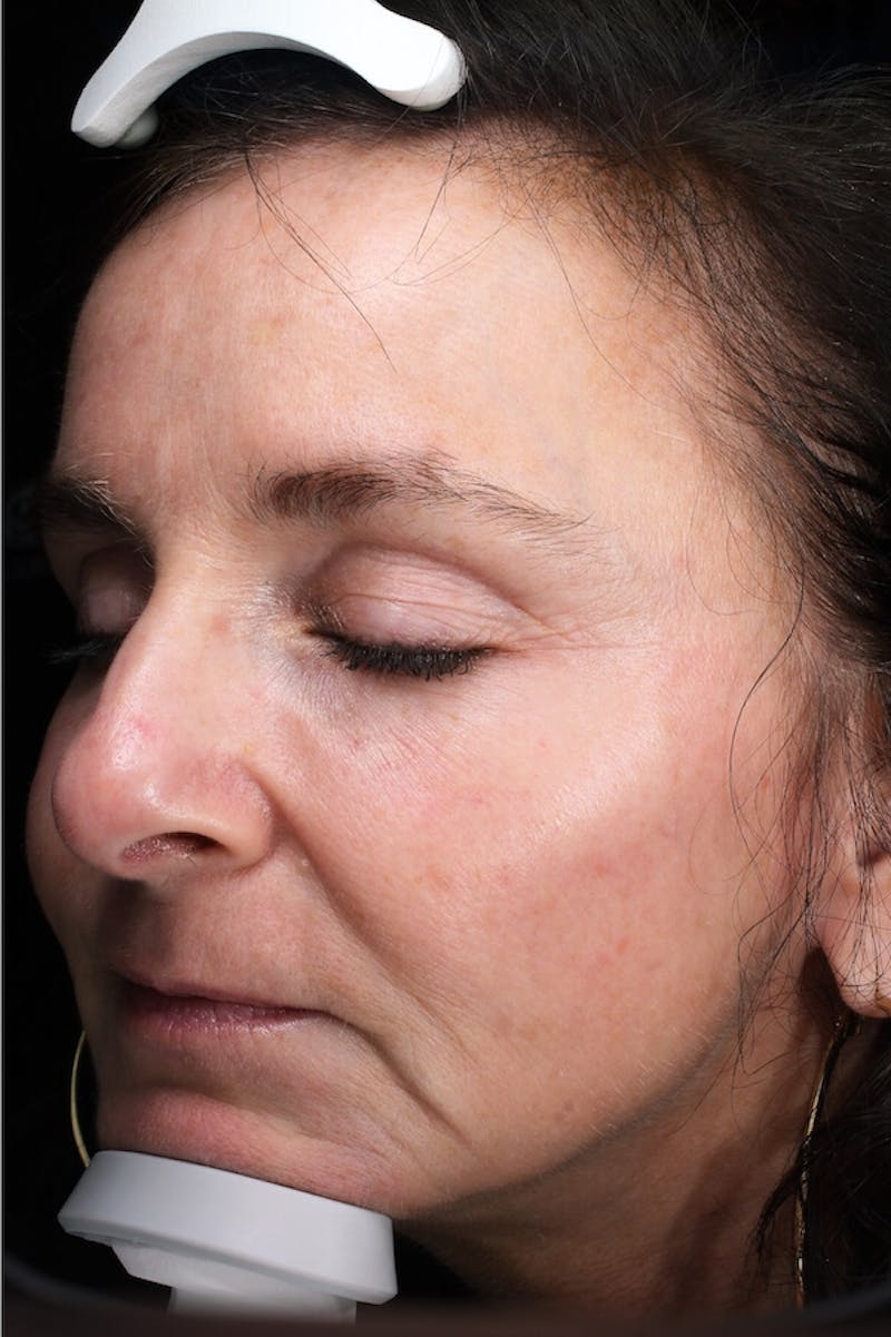 Lasers & Light Before & After Gallery - Patient 793946 - Image 6