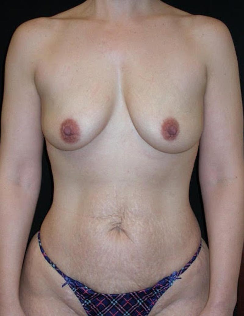 High Definition Mommy Makeover Before & After Gallery - Patient 114116 - Image 1