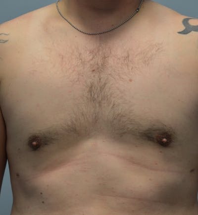Male Breast (Gynecomastia) Before & After Gallery - Patient 365568 - Image 2
