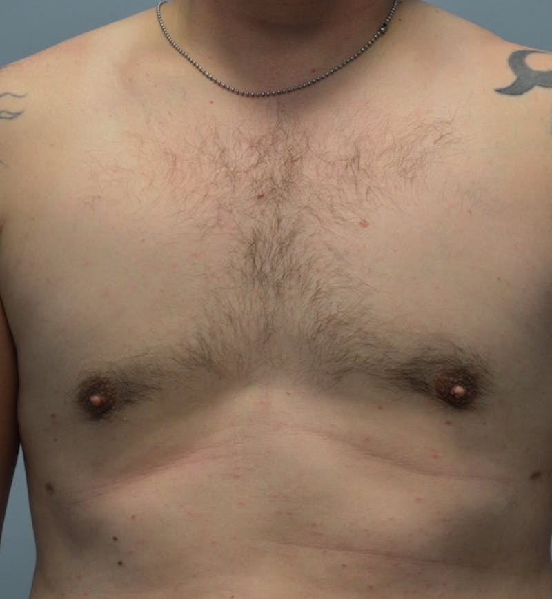 Male Breast (Gynecomastia) Before & After Gallery - Patient 365568 - Image 2