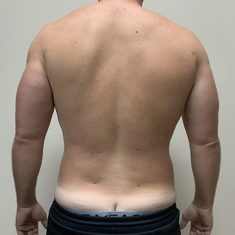 Hi Def Liposuction Before & After Gallery - Patient 310712 - Image 6