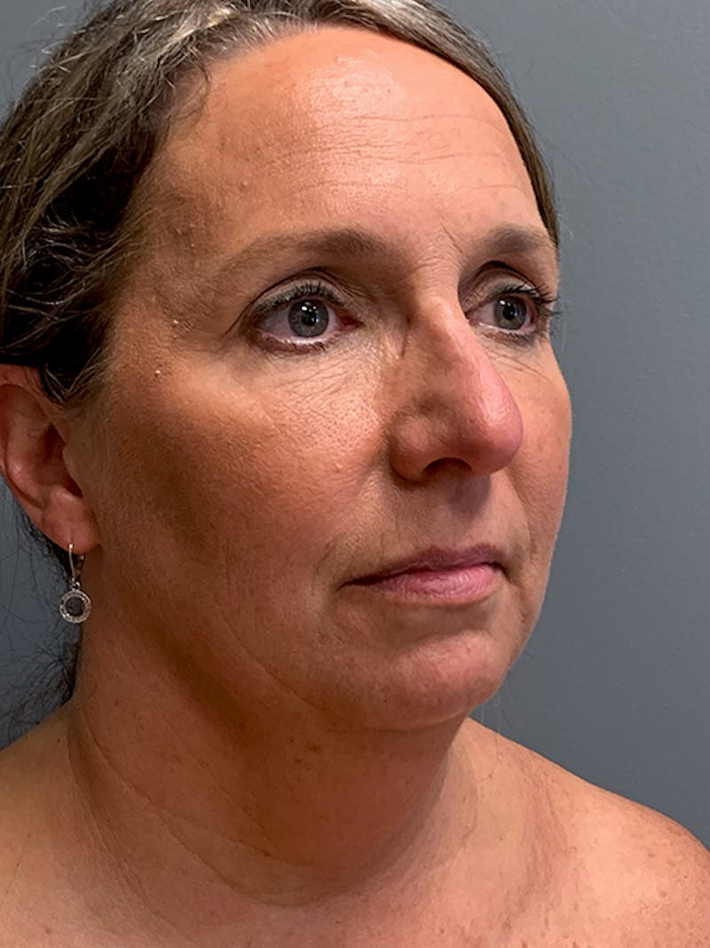 Rhinoplasty Before & After Gallery - Patient 124956 - Image 3