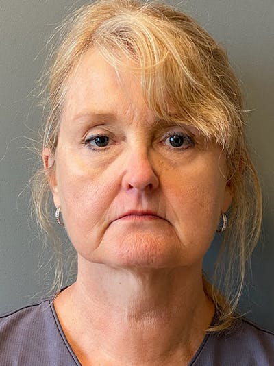 Deep Plane Facelift Before & After Gallery - Patient 109759 - Image 1