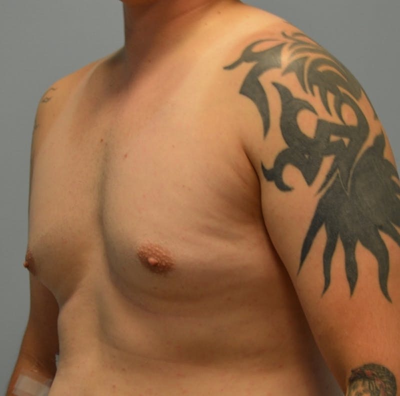 Male Breast (Gynecomastia) Before & After Gallery - Patient 365568 - Image 3